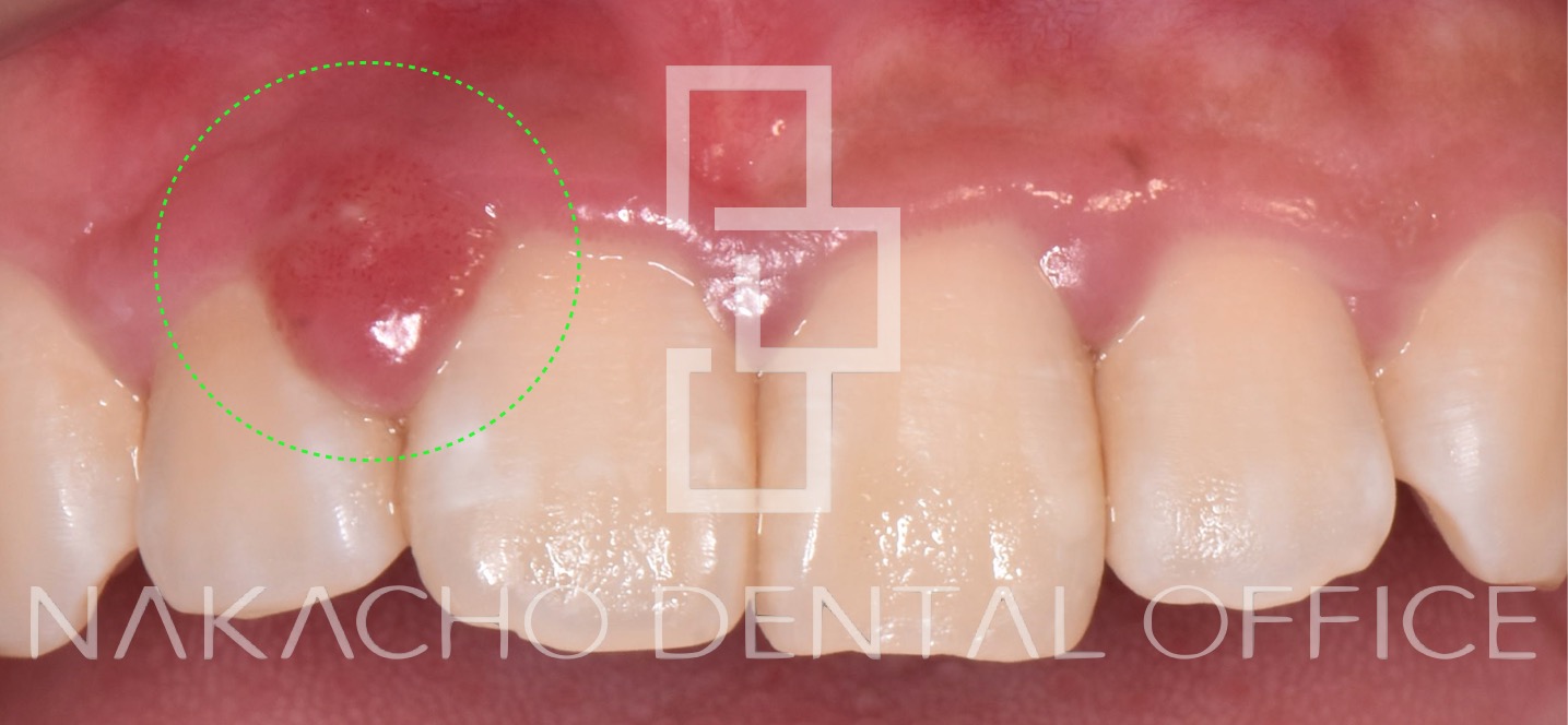 歯ぐきの腫れと出血の原因を読み解く 悪い血を出す Nakacho Dental Office Blog