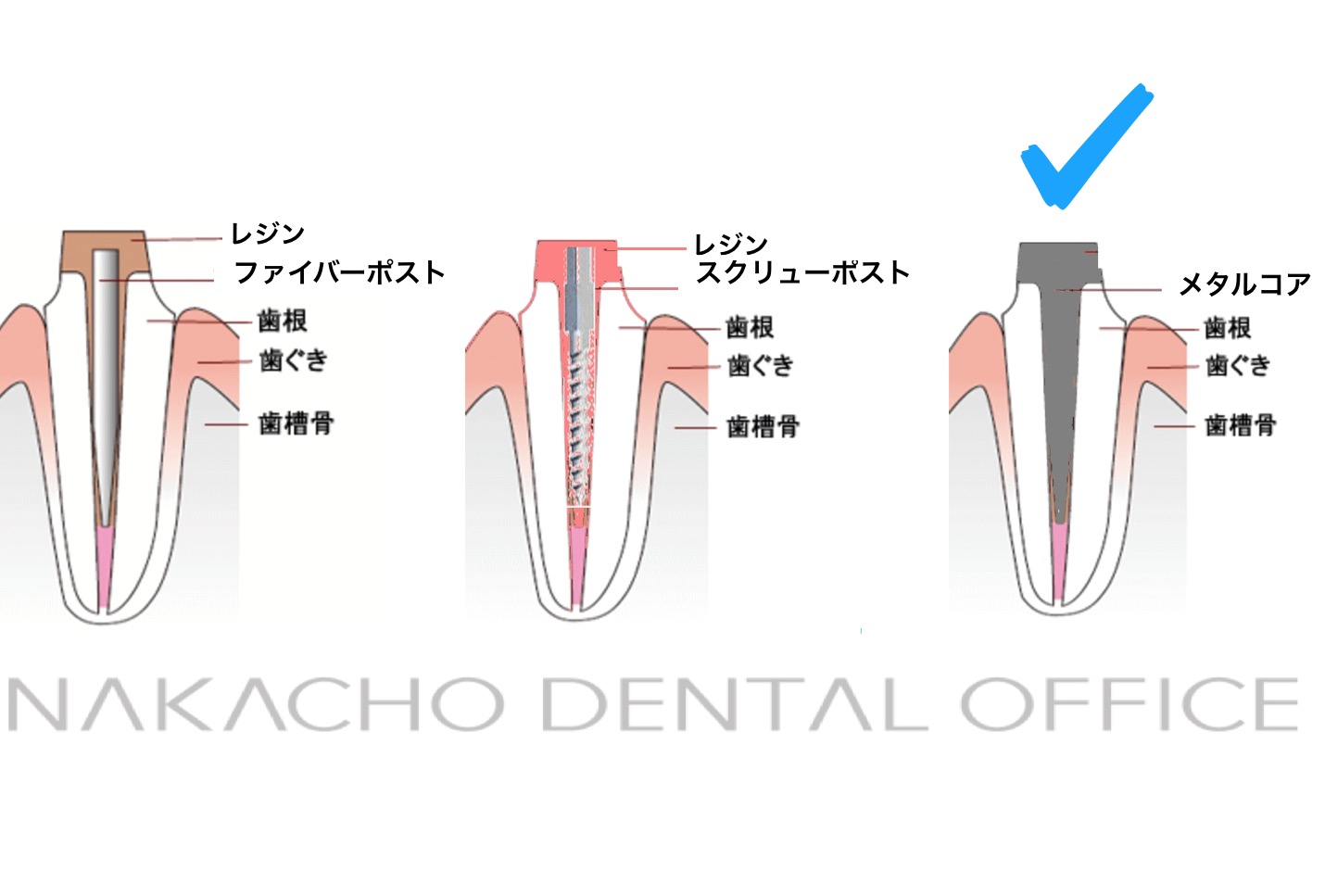 Crtd マイクロスコープを用いた 安全 確実なメタルコアの除去 Nakacho Dental Office Blog