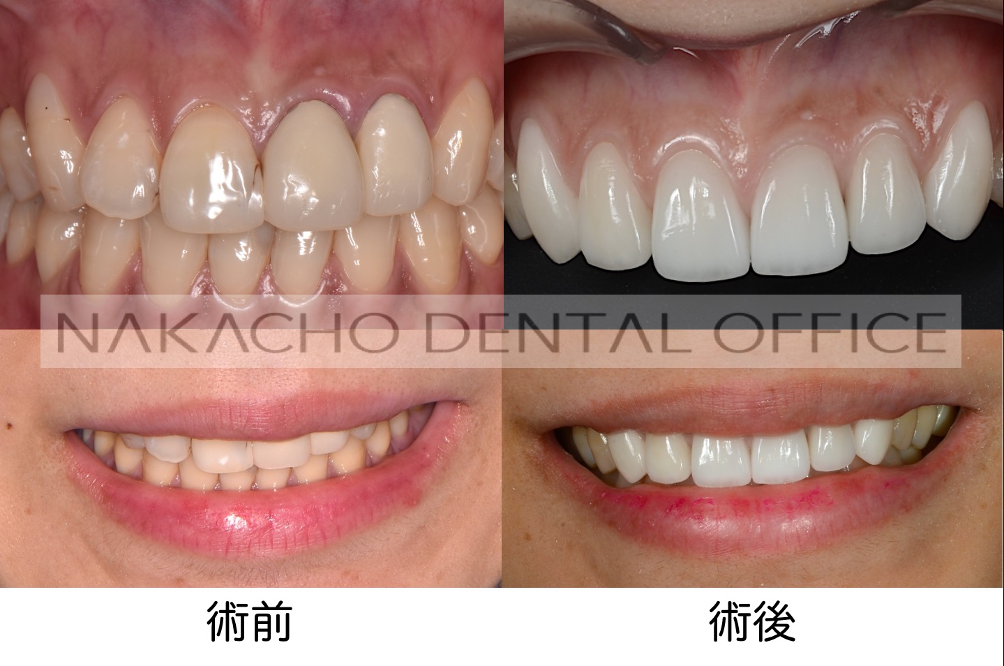 スマイルラインにこだわった審美歯科治療 Nakacho Dental Office Blog
