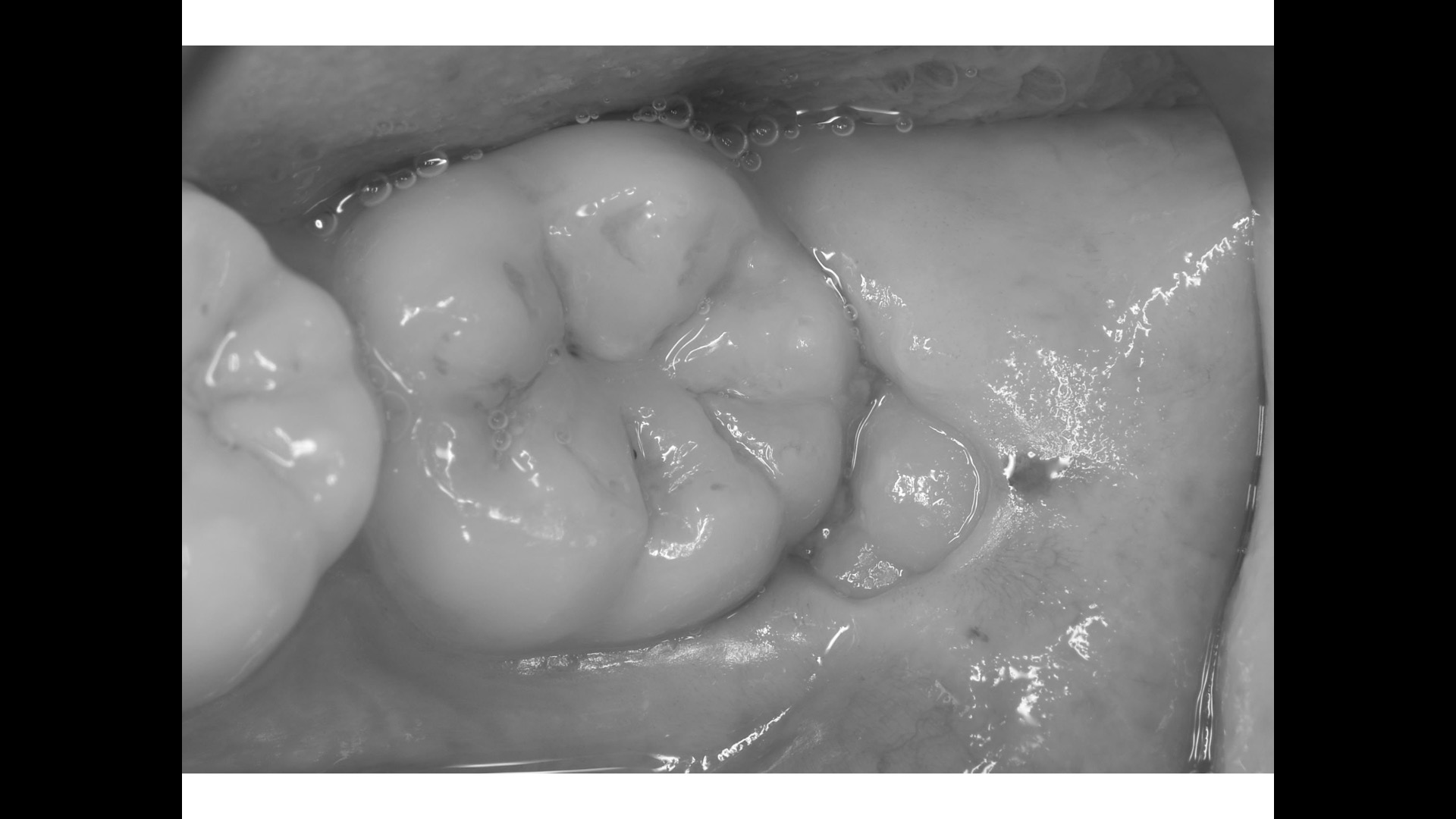 下の横向きになっている親知らずの抜歯 Nakacho Dental Office Blog