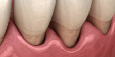 歯根退縮の原因と治療法