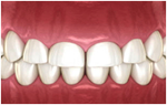 ガミースマイル改善のための『歯冠長延長術』の流れ step1