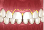 ガミースマイル改善のための『歯冠長延長術』の流れ step2