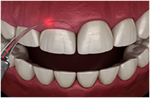 ガミースマイル改善のための『歯冠長延長術』の流れ step3