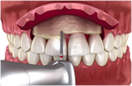 ガミースマイル改善のための『歯冠長延長術』の流れ step4