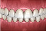ガミースマイル改善のための『歯冠長延長術』の流れ step5